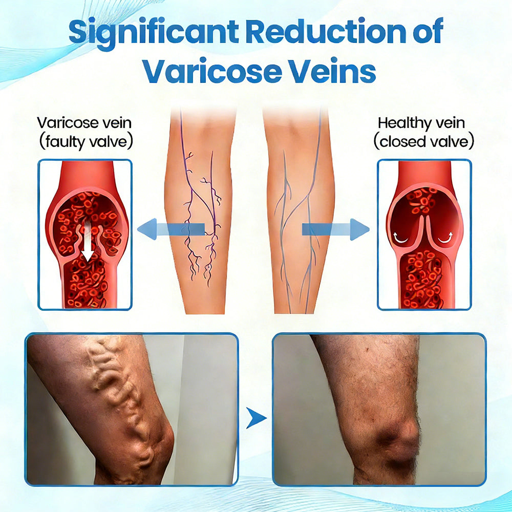 🇺🇸🏆𝗚𝗙𝗢𝗨𝗞® VascuCare Vein Healing Spray(Designed for Varicose veins, Spider veins, Deep vein Thrombosis, Chronic venous insufficiency, Venous ulcers, Thrombophlebitis and other venous issues)