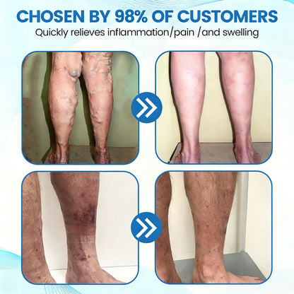 🇺🇸🏆𝗚𝗙𝗢𝗨𝗞® VascuCare Vein Healing Spray(Designed for Varicose veins, Spider veins, Deep vein Thrombosis, Chronic venous insufficiency, Venous ulcers, Thrombophlebitis and other venous issues)