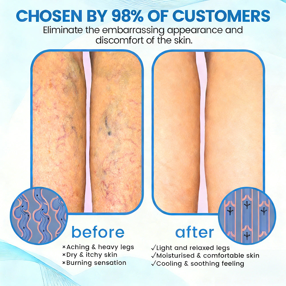 🇺🇸🏆𝗚𝗙𝗢𝗨𝗞® VascuCare Vein Healing Spray(Designed for Varicose veins, Spider veins, Deep vein Thrombosis, Chronic venous insufficiency, Venous ulcers, Thrombophlebitis and other venous issues)