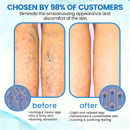🇺🇸🏆𝗚𝗙𝗢𝗨𝗞® VascuCare Vein Healing Spray(Designed for Varicose veins, Spider veins, Deep vein Thrombosis, Chronic venous insufficiency, Venous ulcers, Thrombophlebitis and other venous issues)