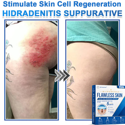 ✅ DR.Fachmer® 2-in-1 Microneedle & Hydrocolloid Patch | Raised Moles,Acne,  Flat Warts & Skin Tags Remover | Improves Wrinkles, Scars & Blemishes | Invisible Pimple Patches for Face & Body