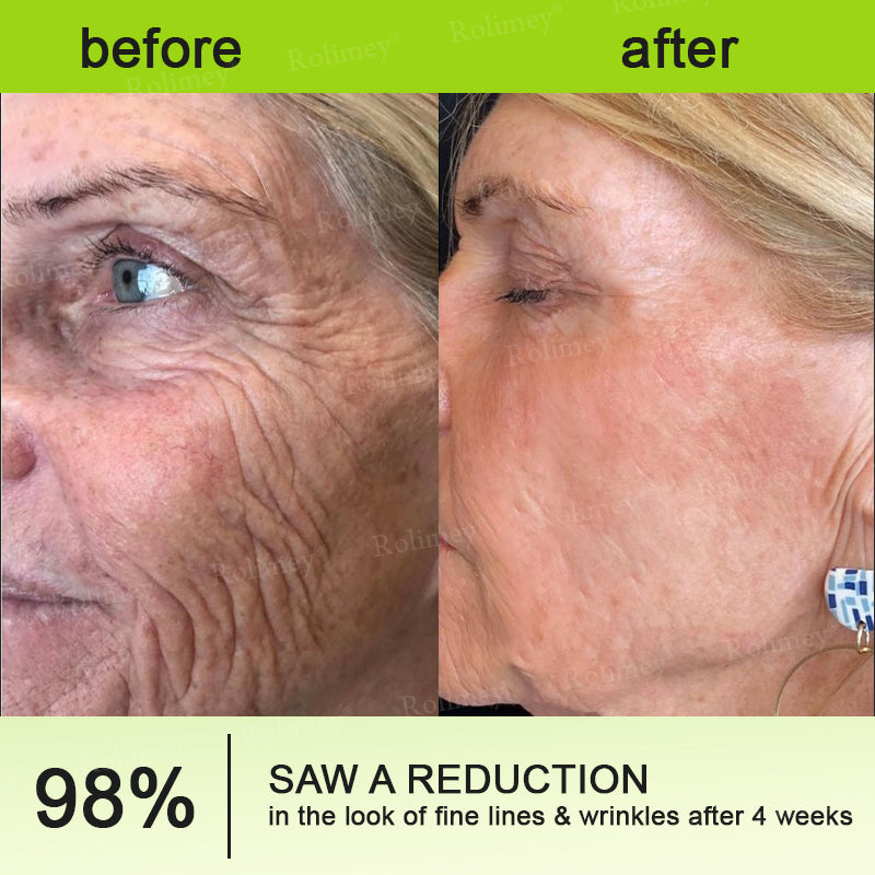 🇺🇸Made and shipped from the USA 💥Rolimey® Botox & Vita-A Retinol Shot Wrinkle-Lift Tightening cream - Last Day Promotion 70% OFF (Copy)