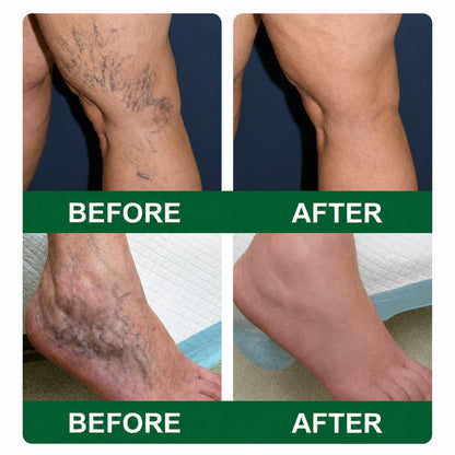 🌿DR.Fachmer® Vein Ease Microneedle Care Patch(For Spider Veins, Varicose Veins, Swelling & Leg Fatigue) - Last Day Promotion 50% OFF