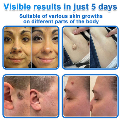 ✅ DR.Fachmer® 2-in-1 Microneedle & Hydrocolloid Patch | Raised Moles,Acne,  Flat Warts & Skin Tags Remover | Improves Wrinkles, Scars & Blemishes | Invisible Pimple Patches for Face & Body
