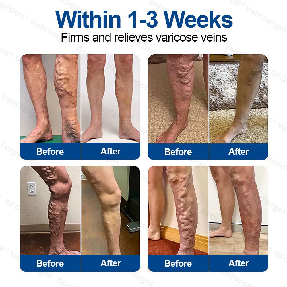 🇺🇸👨‍⚕️✅GFOUK® VeinTarget Microneedle Patch⚡Instant Relief, Long-Term Results