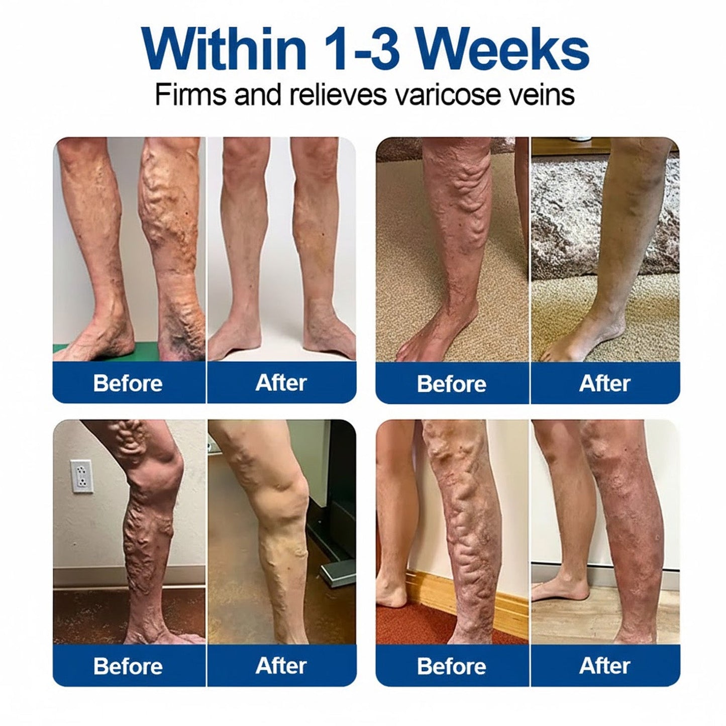 🇺🇸💥GFOUK® VeinEase Microneedle Care Patch⚡Instant Relief, Long-Term Results