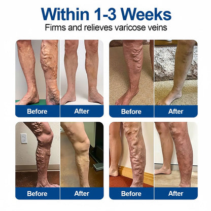 🇺🇸💥GFOUK® VeinEase Microneedle Care Patch⚡Instant Relief, Long-Term Results